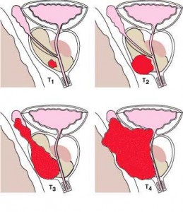 Clinical Staging of Prostate Cancer