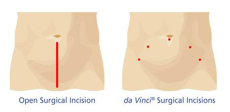 Open Surgical Incision vs. da Vinci® Surgical Incisions