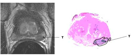 MRI Prostate Investigation